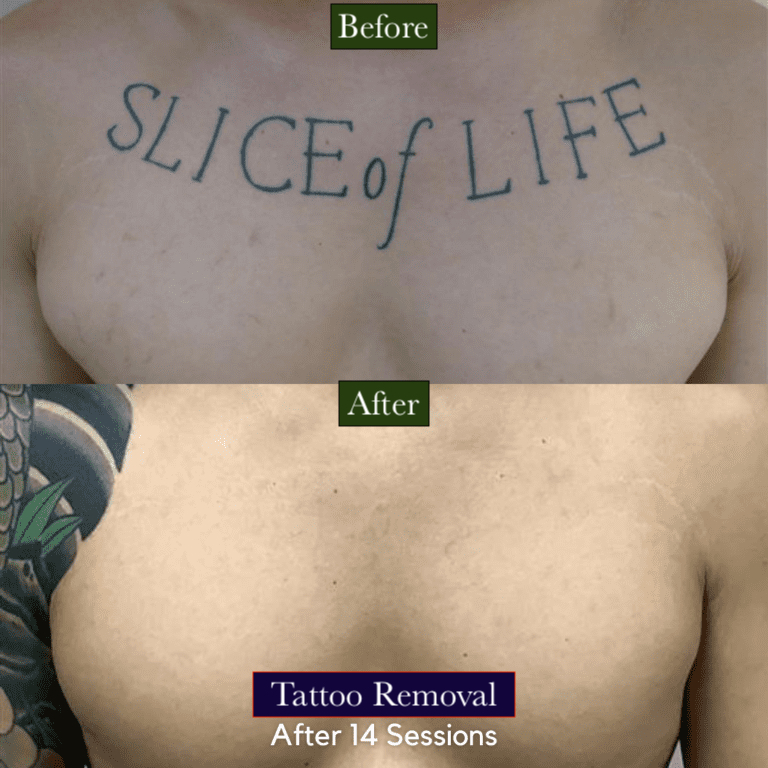 Tattoo Removal Treatment